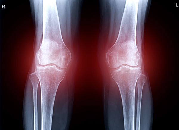 xray of knees